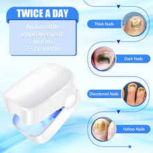 Rechargeable Nail Fungus Laser – Anti-Fungal Device for Toenails, Hands & Feet (Home Use)
